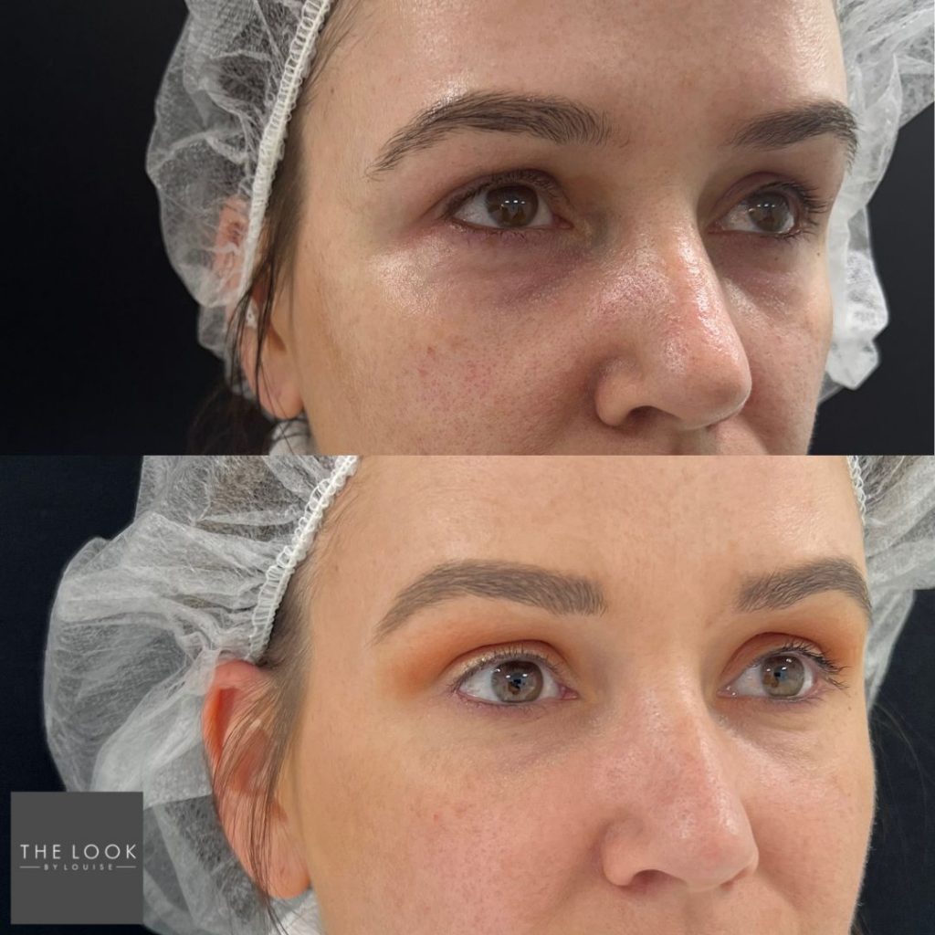 Morpheus8 Eye Before and After