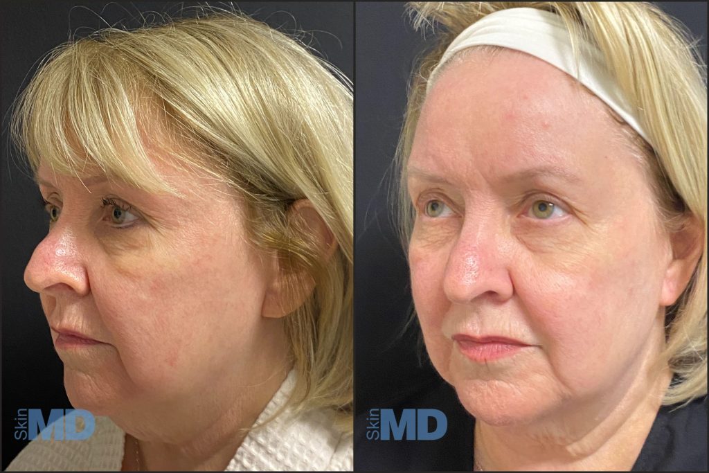 Before and After Jowls Morpheus 8