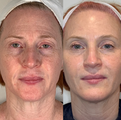 Morpheus8 Before and After - 3 Treatments