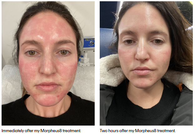 Morpheus8 Before and After - 1 Treatment