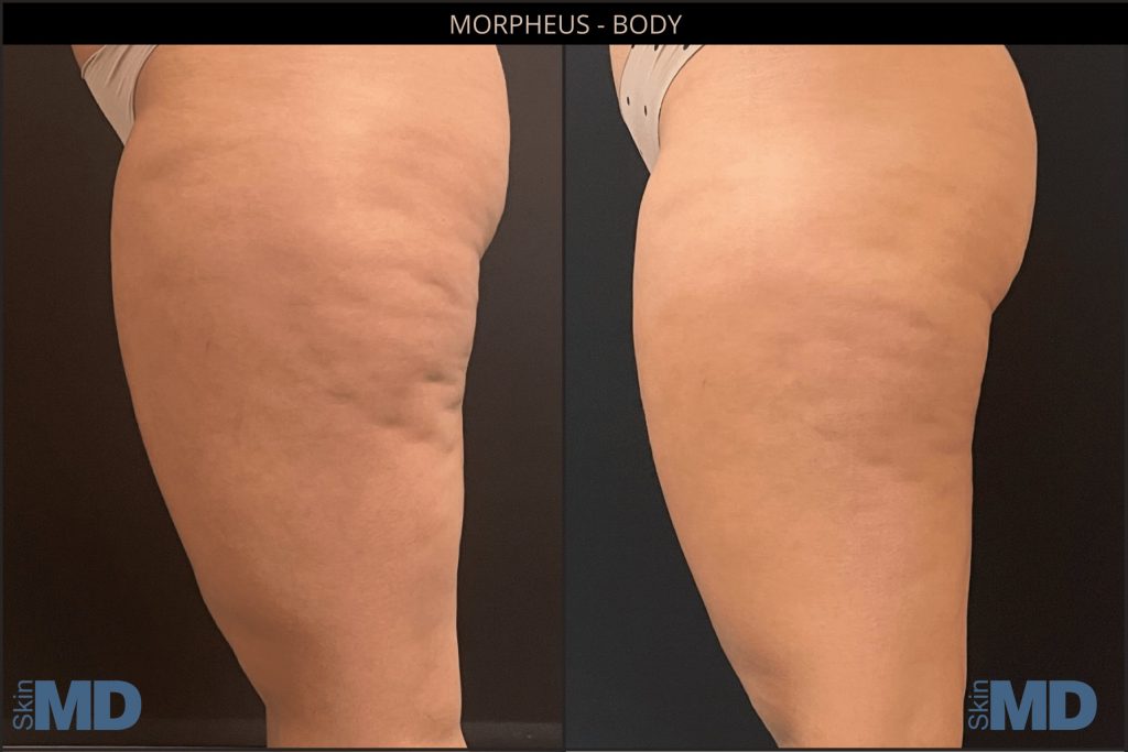 Morpheus8 Before and After Legs