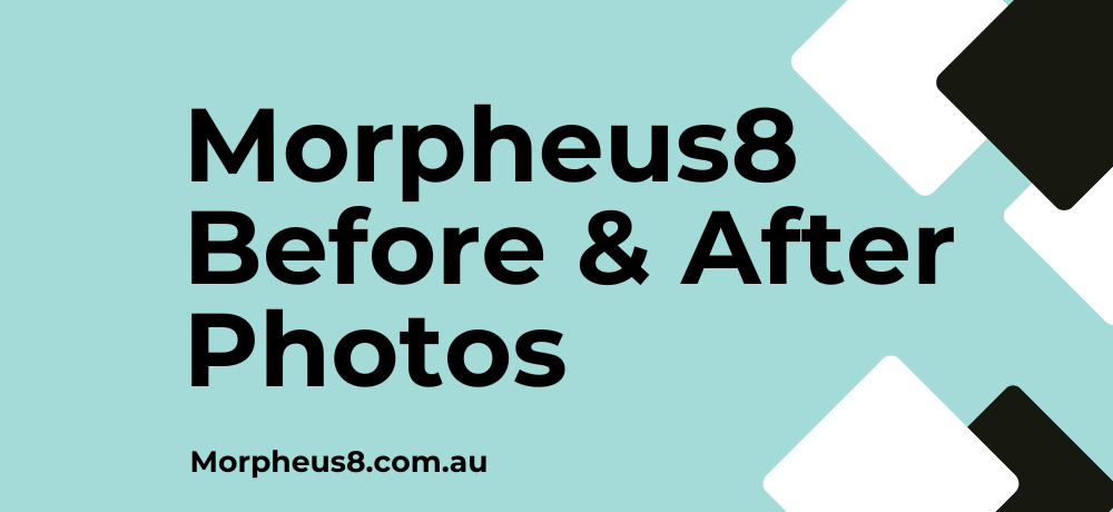 Morpheus8 Before and After Photos