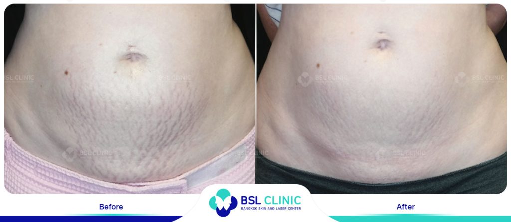 Stomach Stretch Marks Morpheus8 Results