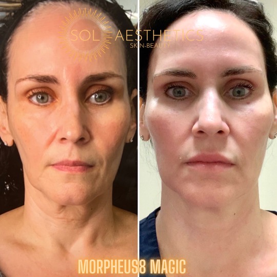 Morpheus8 Face Before and After