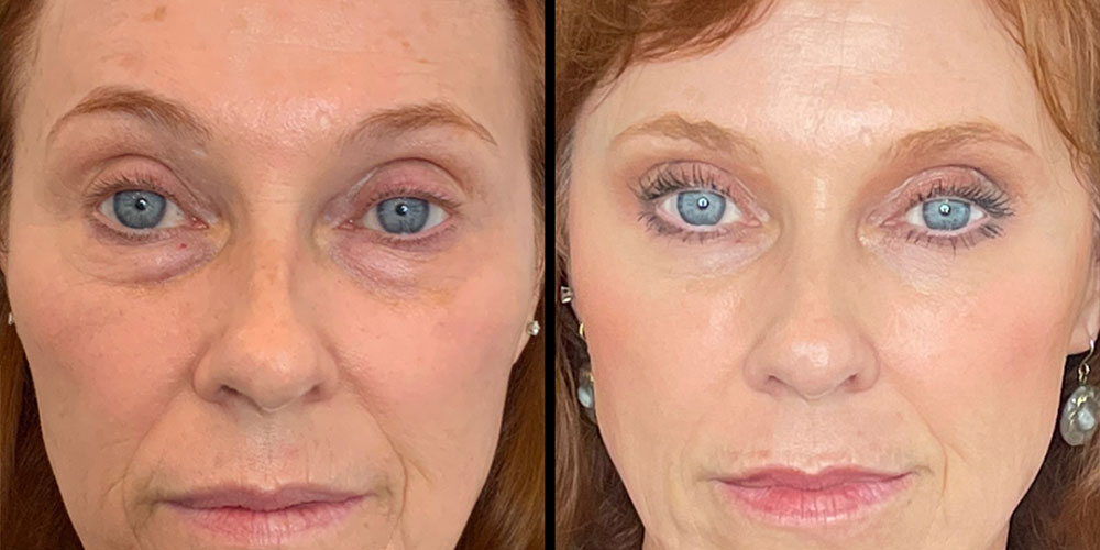 Under Eyes Before and After For Morpheus8