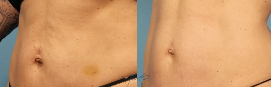 Morpheus8 Stomach Before and After