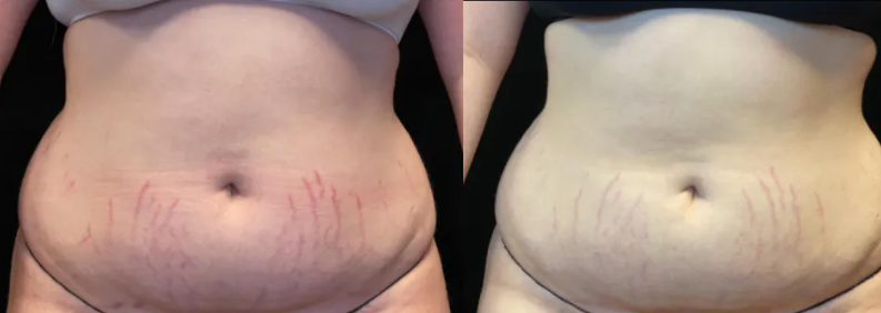 Morpheus8 Stretch Marks Before And After
