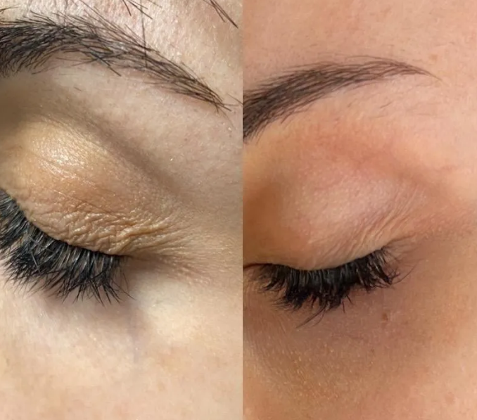Morpheus8 Before and After Eyelids