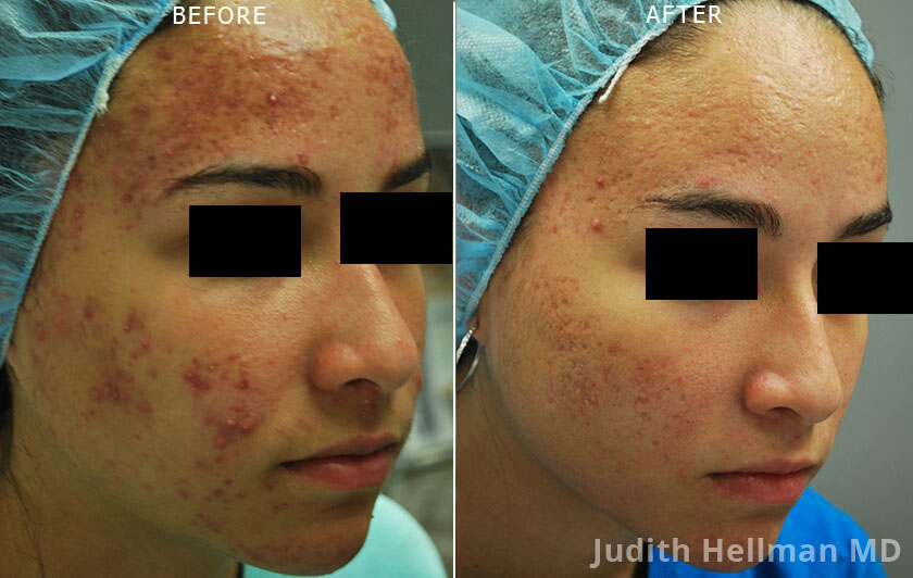 Morpheus8 Before and After Acne Scars