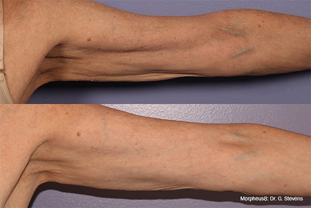 Morpheus8 Before and After Arms