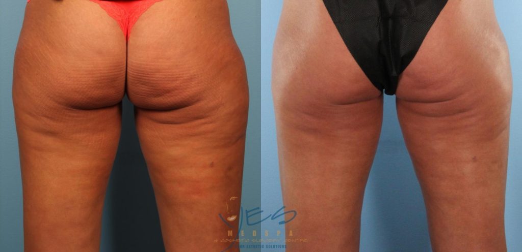 Morpheus8 Before and After Cellulite