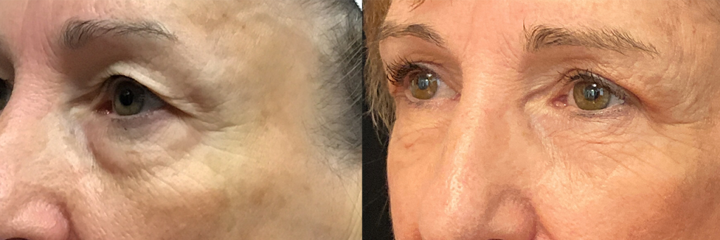 Morpheus8 Before and After Eyes