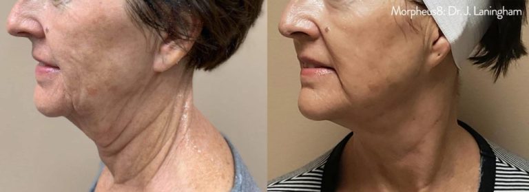 Morpheus8 Before And After Photos And Results Face Neck And More