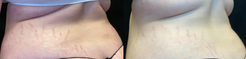 Back Stretch Marks Before and After Morpheus8